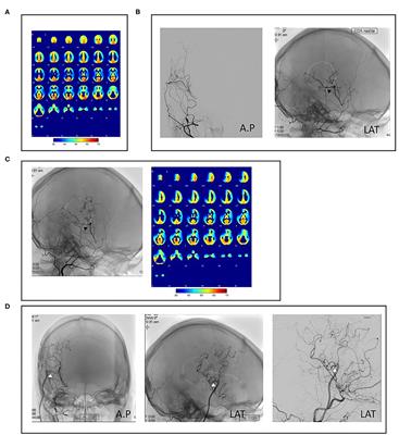 Surgical Management of Failed Revascularization in Moyamoya Vasculopathy